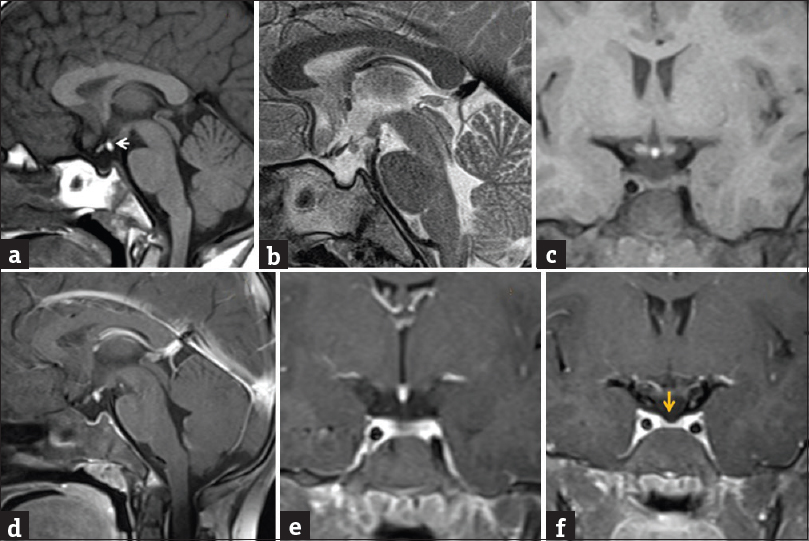 A 13-year-old dwarf male presented with delayed developmental milestone. Noncontrast sagittal T1-weighted image, sagittal T2-weighted image, and coronal T1-weighted images (a-c) showed invisible pituitary stalk with ectopic location of T1-weighted image bright and T2-weighted image hypointense posterior pituitary in lower most portion of median eminence (←arrow). Postgadolinium fat-saturated sagittal T1-weighted image and coronal T1-weighted images (d-f) showed nonvisualized pituitary stalk with thinned out anterior pituitary gland (yellow ↓ arrow).