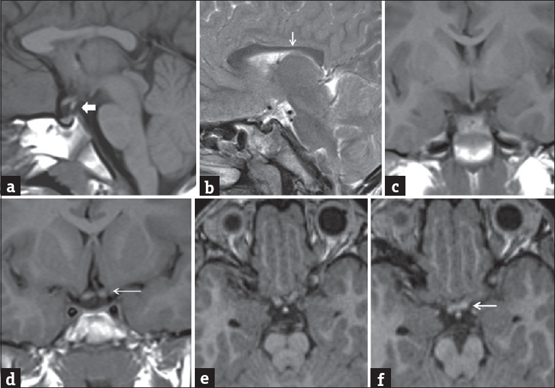 A 7-old-year male presented with delayed developmental milestone with seizures. Noncontrast sagittal T1-weighted image (a) and sagittal T2-weighted image (b) showed interrupted pituitary stalk (block ← arrow) with faintly visualized slight T1-weighted image hyperintense posterior pituitary bright spot in median eminence. Thinning and irregular contour of posterior body of corpus callosum were noted (↓arrow). Noncontrast coronal T1-weighted images (c and d) and axial magnetization-prepared rapid gradient-echo (e and f) showed atrophied optic chiasma and left optic nerve (←arrow).
