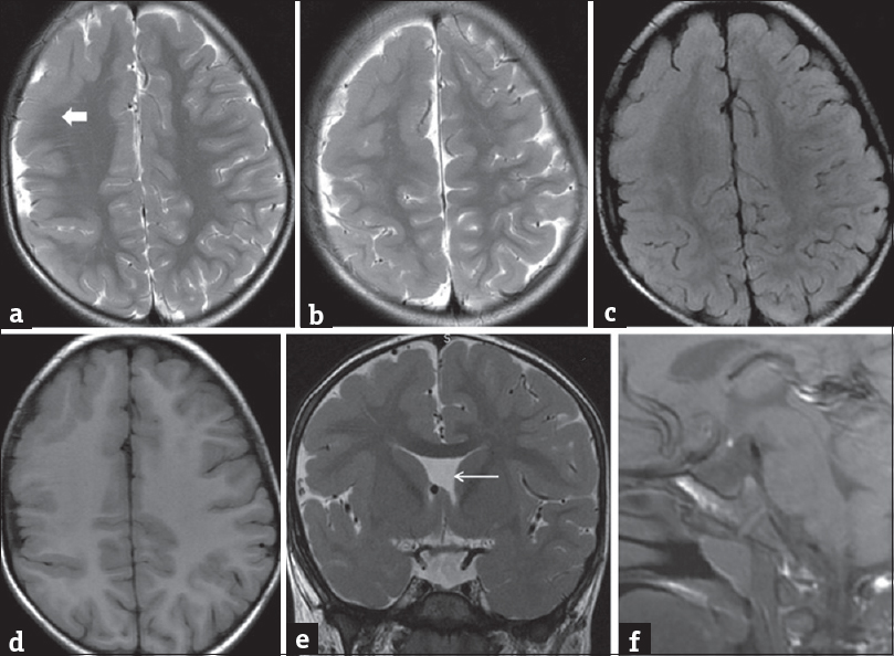 A 3-year-old male patient presented with repeated episodes of seizures. Axial T2-weighted image (a and b), fluid-attenuated inversion recovery (c), and T1-weighted (d) images showed agyria-pachygyria along the right cerebral hemispheric cortices with indistinct gray-white matter differentiations (block ← arrow). Coronal T2-weighted image (e) showed the absence of septum pellucidum (←arrow). Sagittal T1-weighted image (f) showed invisible pituitary stalk with ectopic T1 bright posterior pituitary in median eminence.