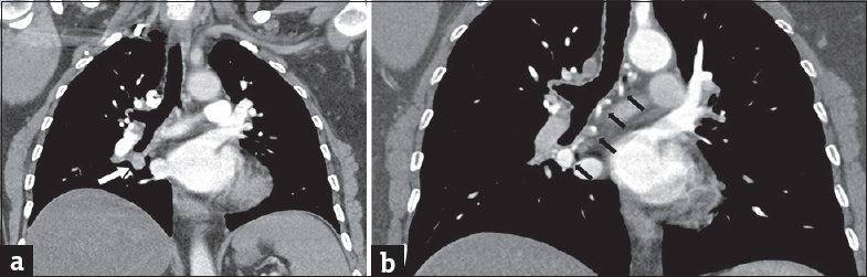 A 63-year-old woman without significant medical history who presented with subacute onset of dyspnea on exertion. (a) Computed tomography pulmonary angiogram highlights the pulmonary arteries; there is a note of a nonspecific infrahilar mass (white arrow). (b) Repeat computed tomography arteriogram allows tracing of bronchial artery (black arrows). Previously noted infrahilar mass is highlighted suggesting bronchial artery aneurysm.