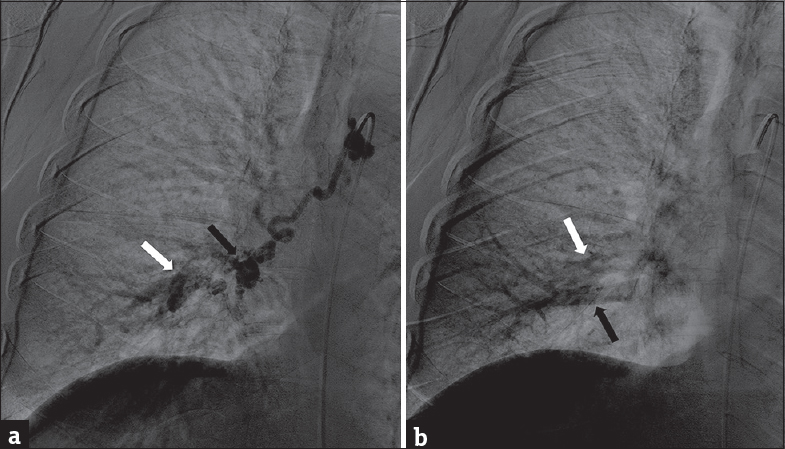 A 63-year-old woman without significant medical history who presented with subacute onset of dyspnea on exertion. (a) Bronchial artery angiogram with contrast injected directly into the bronchial artery under video fluoroscopy shows contrast filling of the bronchial artery aneurysm (black arrow) and simultaneous filling of the pulmonary artery (white arrow). On video fluoroscopy, contrast was noted to flow outward toward the lung periphery. (b) Bronchial artery angiogram after slight time delay shows contrast fading from pulmonary artery (white arrow) and flowing inward toward the hila through pulmonary vein (black arrow). This was, therefore, consistent with bronchial artery to pulmonary artery fistula rather than bronchial artery to pulmonary artery fistula.