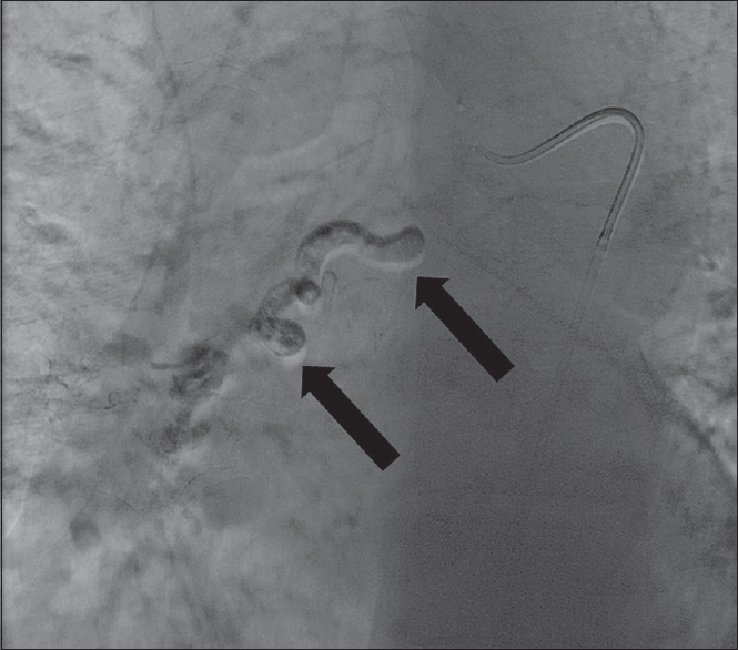 A 63-year-old woman without significant medical history who presented with subacute onset of dyspnea on exertion. Successful postembolization bronchial artery angiogram shows cyanoacrylate glue outlining and occluding the distal bronchial artery (black arrow).