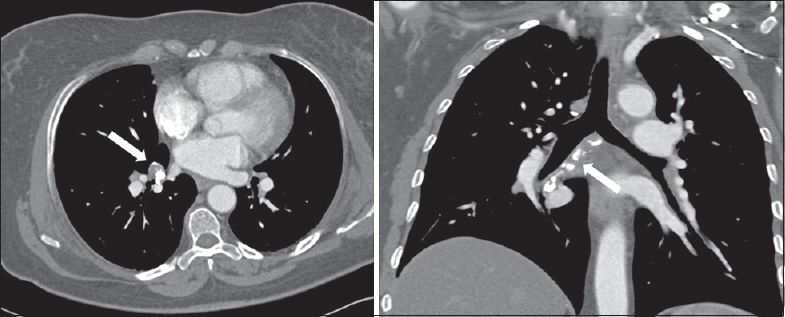 A 63-year-old woman without significant medical history who presented with subacute onset of dyspnea on exertion. One-year status-postembolization follow-up, computed tomography angiogram confirming durable bronchial artery occlusion (white arrows) without notable expansion of bronchial artery aneurysm.