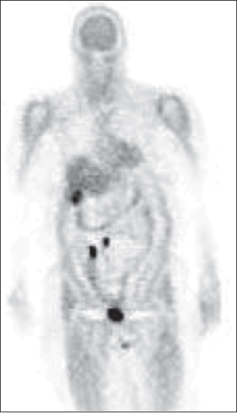 63-year-old woman (#13) with carcinoid identified on prior biopsy of terminal ileum. Previously, In-111-octreotide was unremarkable. Coronal image (head/low thighs) of positron-emission tomography scan obtained after oral administration of carbidopa and postintravenous injection of fluorine-18-fluorodihydroxyphenylalanine shows abnormal foci of fluorine-18-fluorodihydroxyphenylalanine accumulation: Two in the right lower abdomen and one at the lower tip of the right hepatic lobe. Radiotracer accumulation in the bladder is physiological. Two months later, the patient underwent surgical resection of segment 6 of the liver and terminal ileum; these and two of 26 lymph nodes were found with carcinoid. The patient was alive at least 74 months after the fluorine-18-fluorodihydroxyphenylalanine study.