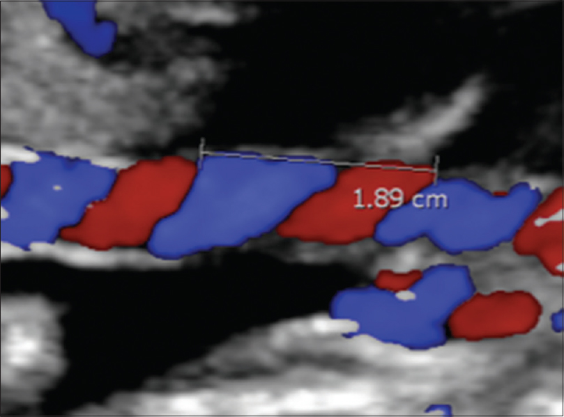 Color Doppler ultrasound showing measurement of the umbilical coiling index from the inner edge of an artery to the outer edge of the same artery at the adjacent umbilical twist along the ipsilateral cord side. The umbilical coiling index was 0.52.