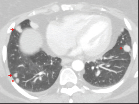 A 47-year-old female with a history of urinary bladder carcinoma presented for follow-up. Axial computed tomography of the chest set to lung windows demonstrates multiple randomly distributed solid nodules (arrows), a pattern typical of hematogenous dissemination of malignancy.