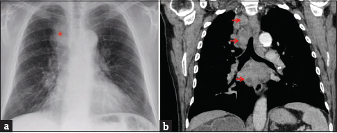 A 68-year-old male with a history of high-grade invasive urinary bladder carcinoma presented with weight loss and left-sided neck swelling. (a) Chest radiograph (posterior-anterior projection) showed a widened right paratracheal stripe (asterisk). The diaphragmatic contours are flattened, suggesting lung hyperinflation. (b) Chest computed tomography set to soft tissue windows (coronal reconstruction) demonstrates bulky paratracheal and subcarinal lymphadenopathy with areas of hypodensity suggestive of necrosis (arrows). Transbronchial needle aspiration of the right paratracheal lymph node revealed metastatic carcinoma histologically compatible with urothelial origin.