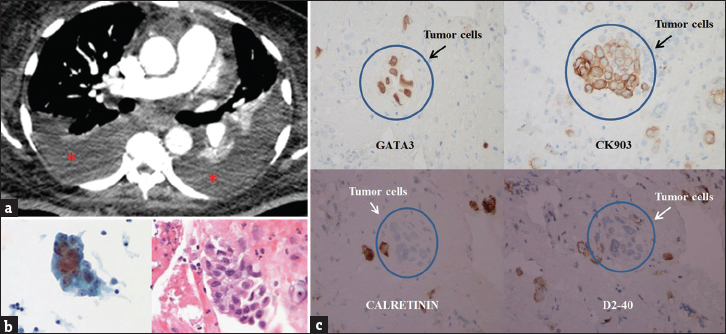 A 54-year-old female with a history of metastatic urinary bladder carcinoma presented with shortness of breath and hypoxemia. (a) Axial chest computed tomography set to soft tissue windows demonstrates bilateral pleural effusions (asterisks) with compressive atelectasis. (b) Cytology from the right pleural effusion demonstrates tumor cells with enlarged nuclei, increased nuclear to cytoplasmic ratio, and irregular nuclear membrane. (c) Immunohistochemistry demonstrates positive staining for GATA-3 and CK903 and negative staining for calretinin and D2-40, a pattern consistent with metastatic urothelial carcinoma.
