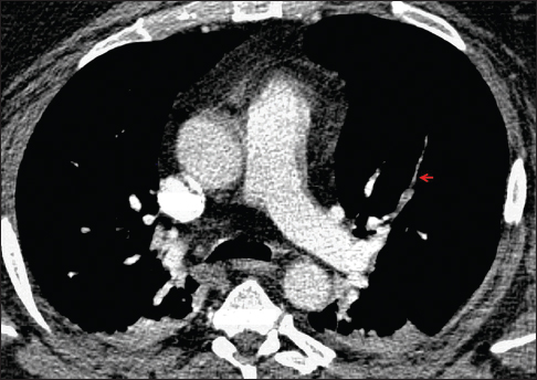 A 47-year-old man with morbid obesity presented for transurethral resection of a bladder mass. Preoperative hypoxemia prompted computed tomography angiography of the chest, which demonstrates multiple filling defects, including in the anterior segmental artery of the left upper lobe (arrow). Treatment with anticoagulation was started and the patient underwent surgical removal of the bladder tumor, which revealed urothelial carcinoma with sarcomatoid features. His postoperative course was complicated by persistent hypoxemia and progression of disease, and the patient ultimately expired. Autopsy findings demonstrated intravascular tumor thrombi identical on microscopic examination to the previously diagnosed tumor.