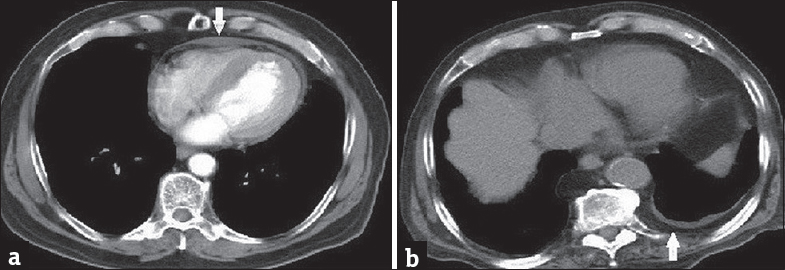 A 68-year-old patient presenting with dyspnea (a) Contrast-enhanced computed tomography image with mediastinal window shows pericardial effusion. A 59-year-old patient presenting with dyspnea (b) Computed tomography image with mediastinal window shows extrapleural fat tissue/pleural thickening.