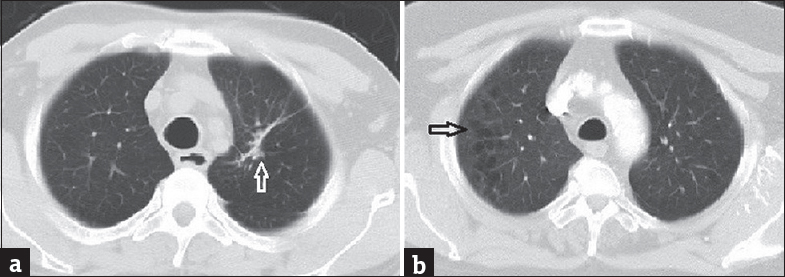 Axial computed tomography images with lung window of two patients (age 68 and 61 years, respectively) presenting with shortness of breath show parenchymal fibrotic band (a) and centrilobular pulmonary emphysema (b)