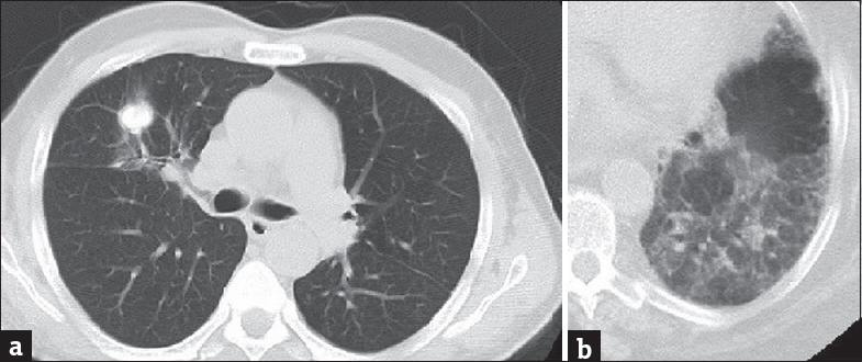 A 68-year-old patient presenting with chronic cough (a) Axial computed tomography image shows pulmonary mass with irregular margins. Contrast-enhanced axial computed tomography image (b) with lung window shows air trapping in a 59-year-old patient presenting with shortness of breath