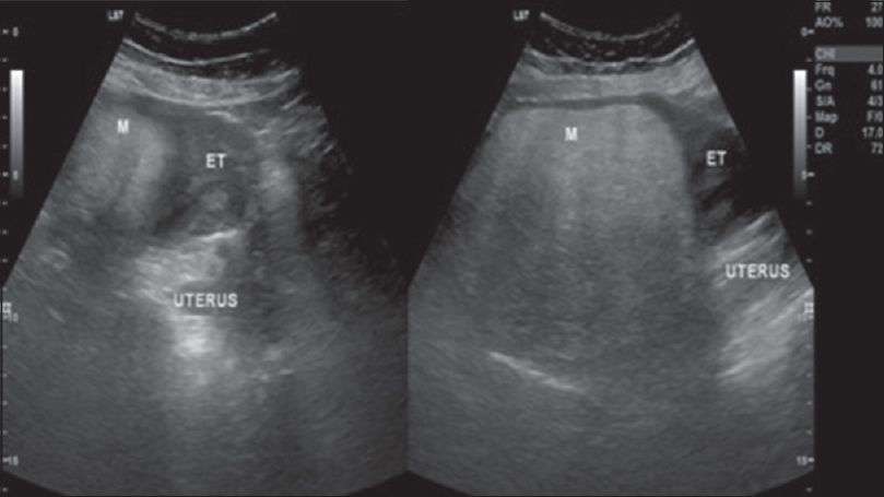 A 52-year-old female presenting with leukorrhea for 2 months. Longitudinal ultrasound images of the pelvis demonstrate a large echogenic mass in the fundus of the uterus.