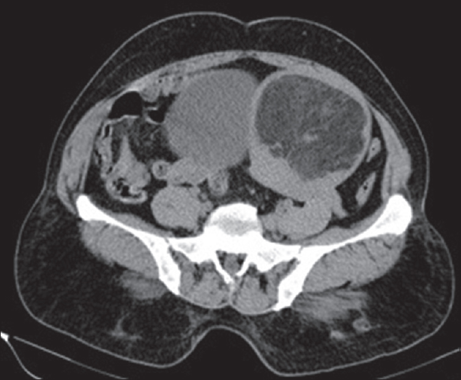 A 52-year-old female presenting with leukorrhea for 2 months. Computed tomography plain axial section of the pelvis demonstrates a predominantly low attenuation mass, corresponding to fat density in the fundus of the uterus.