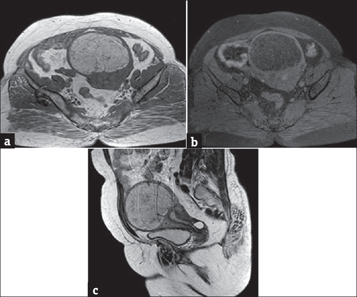 A 52-year-old female presenting with leukorrhea for 2 months. (a) Magnetic resonance imaging T1-weighted image axial section of the pelvis demonstrates a large T1 hyperintense mass in the uterine fundus subserosal myometrium. (b) Magnetic resonance imaging T2 fat suppression sequence axial section of the pelvis demonstrates a predominantly hypointense mass in the uterine fundus subserosal myometrium. (c) Magnetic resonance imaging T2-weighted image sagittal section of the pelvis demonstrates a large T2 hyperintense mass in the uterine fundus subserosal myometrium.