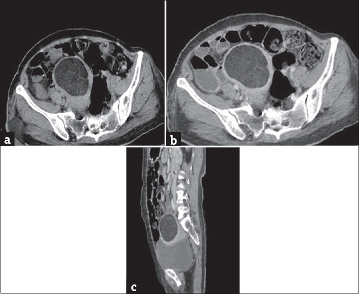 A 55-year-old female presenting with lower abdominal distension for 6 months. (a) Computed tomography plain axial section of pelvis demonstrates a predominantly low attenuation mass, corresponding to fat density in the uterine fundus. (b) Computed tomography contrast axial image of pelvis demonstrates a predominantly low attenuation mass, corresponding to fat density in the myometrium of the uterine fundus with few nonenhancing soft tissue strands noted within. (c) Computed tomography contrast sagittal image of the pelvis demonstrates a predominantly low attenuation mass, corresponding to fat density in the myometrium of the uterine fundus with few nonenhancing soft tissue strands noted within.