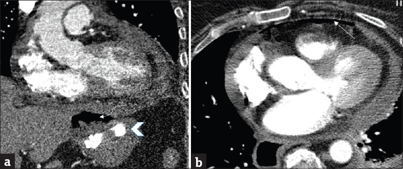 65-year-old female presents with chest pain and shortness of breath 9 years after placement of a laparoscopic gastric band and was transferred to our institution for higher level of care following the results of a computed tomography. (a) Coronal contrast-enhanced computed tomography of the chest in the mediastinal window from an outside hospital shows a laparoscopic gastric band (arrow head) and partial visualization of an abscess adjacent to the gastric band (curved arrow). No direct communication with the pericardium was initially seen. (b) Axial image demonstrates pneumopericardium (arrow) and small pericardial effusion.