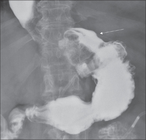 Single contrast upper gastrointestinal examination in the supine anteroposterior view shows increased phi angle and prominent gastric pouch (arrow) concerning for mild lap band slippage.