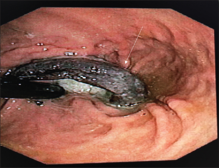 Endoscopic image demonstrates an erosion of the lap band through the gastric wall (arrow).