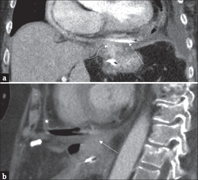 (a) Coronal contrast-enhanced computed tomography shows collection of oral contrast within the pericardial sac (arrow). Communication between the inferior pericardial sac and a contrast-filled perigastric fluid collection is also seen (curved arrow). (b) Sagittal contrast-enhanced computed tomography showing fistulous tract between the perigastric fluid collection and the pericardial sac (arrow).