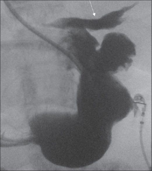 Single contrast upper gastrointestinal in the anteroposterior view shows contrast extravasation into and layering along the inferior pericardial sac (arrow).