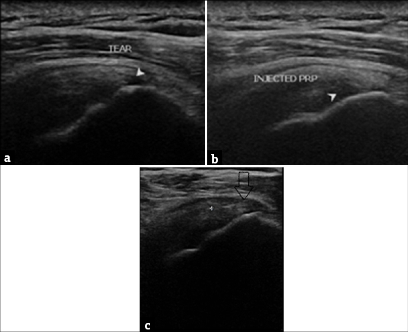 (a) Original, ultrasound image of a 52-year-old male showing articular sided partial supraspinatus tear following a 2 months of conservative management (b) The same patient after ultrasound-guided platelet-rich plasma injection, arrow mark showing injected platelet-rich plasma (c) The same patient evaluated after period of 8 weeks, ultrasound shows healing in the tear site.