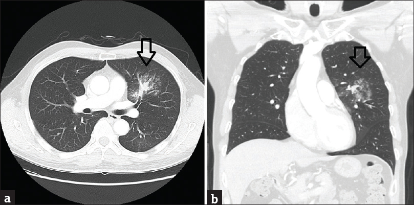 A 60-year-old gentleman, with a history of 6 months on and off blood stained sputum, was admitted for an episode of massive hemoptysis. (a) Selected axial image of urgent computed tomography thorax (lung window) showed focal consolidation with multiple small centrilobular nodules and adjacent ground glass changes (arrow). (b) Selected coronal image of computed tomography thorax could appreciate the adjacent ground glass changes around the focal consolidation at left upper lobe (arrow).
