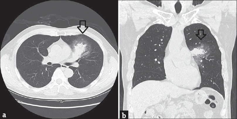 (a) With repeated hemoptysis, investigation with high resolution computed tomography after a month (selected axial image) showed the left upper lobe mass is significantly enlarged (arrow). (b) Selected coronal image of high resolution computed tomography could appreciate the ground glass halo around the enlarged lung mass (arrow).