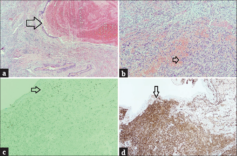 Histopathological examination of lobectomy of left upper lobe. (a) Showed hemorrhage into the bronchiole (arrow). It correlated with the computed tomography images of ground glass changes around the mass. (b) Histopathological examination showed the tumor comprised sheets of loosely cohesive malignant tumor cells which had eccentric markedly pleomorphic nuclei, prominent nucleoli, vesicular with the presence of fine strands of chromatin, and moderate amount of eosinophilic cytoplasm.(high power). (c) Tumor cells stained positive for ERG, a vascular-specific marker (magnification power, ×100). (d) Tumor cells stained positive for CD31, a vascular-specific marker (magnification power, ×40).