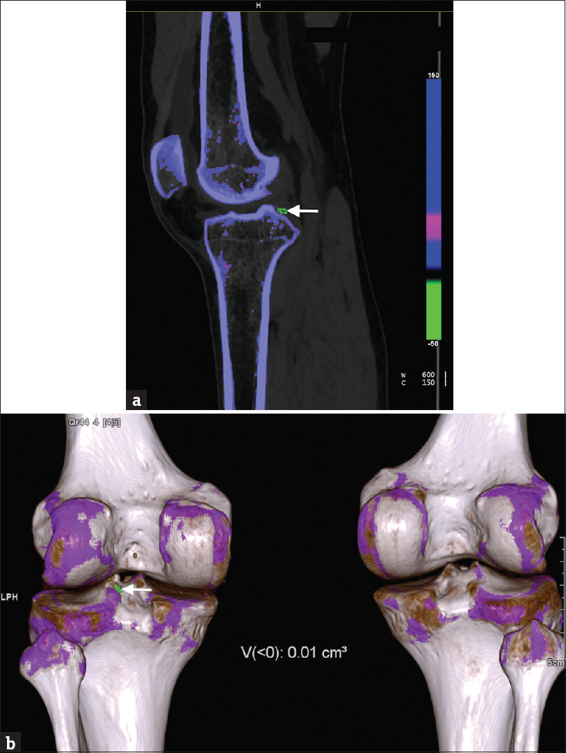 (a) A 28-year-old man with gout depicting monosodium urate crystal deposition in the left knee joint on dual energy computed tomography. A cross-sectional (sagittal) color-coded image of the left knee joint using multiplanar reconstruction demonstrates presence of urate deposits (green) in periarticular soft tissue (arrow). The uric acid deposits appear different from osseous structures containing calcium (blue). (b) Volume-rendered color-coded image of both the knee joints depicts presence of monosodium urate crystals in periarticular soft tissue of the left knee joint (arrow). The automated software also calculates the volume of the crystals which was 0.01 cm3 in this patient (as mentioned in figure). The volume-rendered images depict the anatomic relationship between the uric acid deposits and the osseous structures (blue and white).