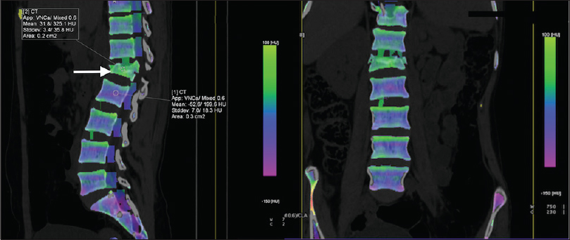 An 18-year-old female with vertebral compression fracture and bone edema. Cross-sectional (sagittal and coronal) color-coded three-material decomposition (water, fat and calcium) images obtained using virtual noncalcium technique show collapse of L1 vertebral body with presence of bone marrow edema (arrow) as high attenuation area appearing dense green. The region of interest (arrow) shows high mean HU value as compared to the normal (as indicated in L2 vertebra), indicating bone edema.