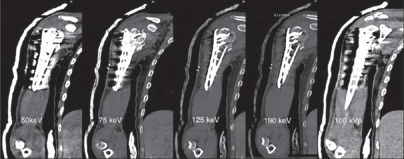 A 30-year-old man with open reduction and internal fixation of the head and the neck of right humerus. Shown are coronal dual energy computed tomography images reconstructed using monoenergetic spectrum application on a multimodality workstation at monoenergies as mentioned on the respective images (left to right). Reduction of beam hardening artifact is seen at 125 and 190 keV as compared to simulated conventional CT image obtained at 100 kVp (on extreme right). The visibility of lateral chest wall, adjacent soft tissues is markedly improved at higher keV.
