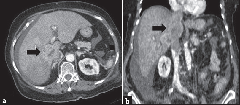 Imaging of a hepatic perivascular epithelioid cell tumor. (a) Contrast-enhanced arterial phase of computed tomography reveals a poorly defined mass with marked enhancement and inferior vena cava invasion. (b) Coronal reconstruction of venous phase contrast-enhanced computed tomography shows relatively washout of mass with unclear borders. Tumor thrombus in inferior vena cava is also seen clearly in coronal multidetector computed tomography image.