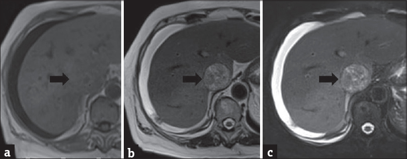 Axial T1-weighted (a), T2-weighted (b), and fat-suppressed T2-weighted (c) magnetic resonance imaging images demonstrate T1-isointense, T2 and fat-suppressed T2-hyperintense mass component of liver perivascular epithelioid cell tumor in vena cava inferior.