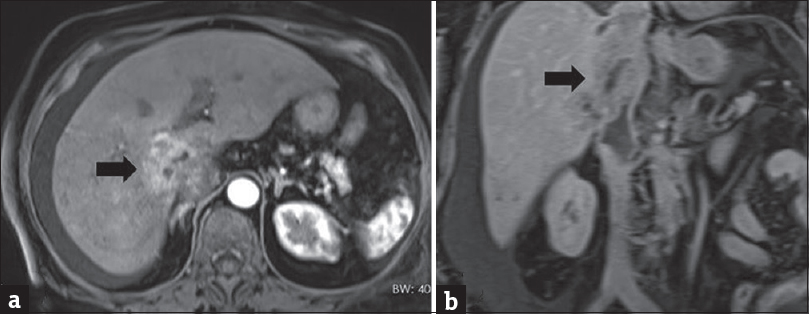 Postgadolinium fat-suppressed axial arterial phase (a), and coronal venous phase images demonstrate a large liver perivascular epithelioid cell tumor that marked heterogeneous enhancement in arterial phase, and washout in venous phase with prominent invasion of inferior vena cava. Tumor thrombus is markedly seen in late venous phase (b).