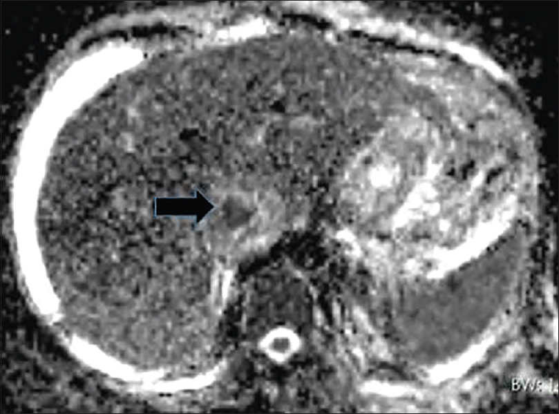 Diffusion-weighted image of perivascular epithelioid cell tumor (black arrow). Marked diffusion restriction of malign perivascular epithelioid cell tumor is seen as hypointense signal change on apparent diffusion coefficient map.