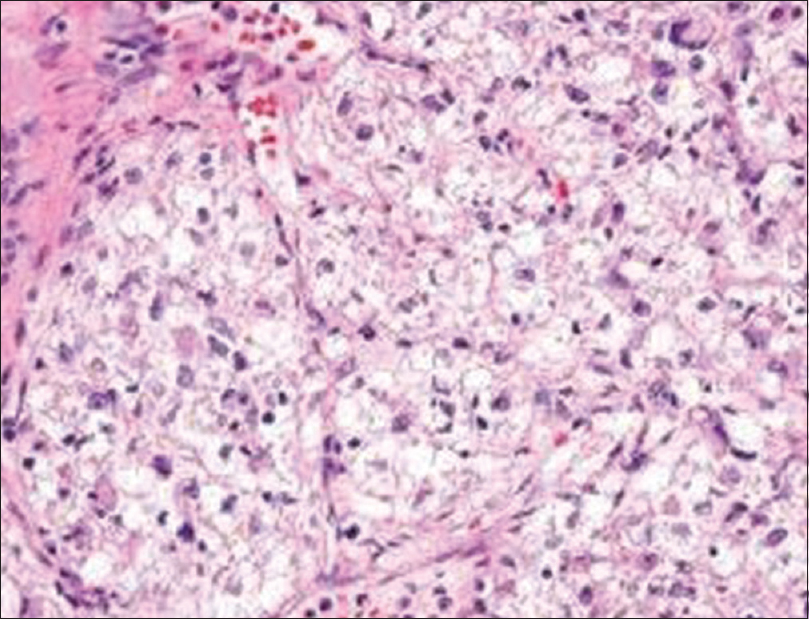 Histopathologic findings of malign perivascular epithelioid cell tumor; photomicrograph (H and E, ×400) shows specimen is composed of nests of large epithelioid cells with clear-to-granular eosinophilic cytoplasm. There is also seen severe nuclear atypia that indicates of malign tumor.