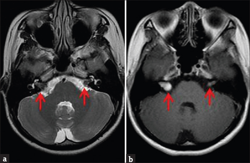 Contrast-enhanced brain magnetic resonance imaging in a patient with clinical diagnosis of neurofibromatosis Type 2. (a) Axial T2-weighted sequence demonstrates small bilateral isointense vestibular masses (arrows). (b) Enhanced T1-weighted sequence demonstrates enhancement of the masses. Right-sided mass is larger, causing mild expansion of the internal acoustic canal and an “ice-cream cone” appearance. Bilateral vestibular schwannomas are most commonly seen in patients with neurofibromatosis Type 2.