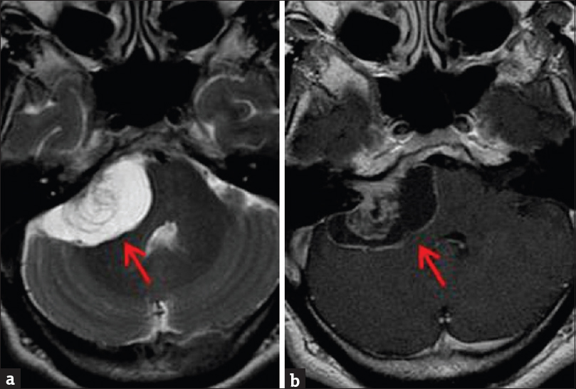 Contrast-enhanced brain magnetic resonance imaging. (a) Axial T2-weighted sequence demonstrates a right vestibular mass with high T2 signal correlating with areas of cystic degeneration (arrow). (b) Enhanced T1-weighted sequence demonstrates mild heterogeneous enhancement of the solid portions of the mass, with low T1 signal correlating with the cystic component (arrow).