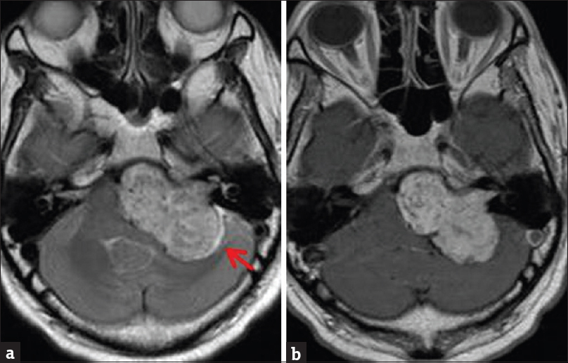 Contrast-enhanced brain magnetic resonance imaging. (a) Axial T2-weighted sequence demonstrates large hyperintense left vestibular mass with extension into the internal auditory canal. Note a high T2 signal cerebrospinal fluid cleft laterally (arrow). (b) Enhanced T1-weighted sequence demonstrates heterogeneous mass enhancement.