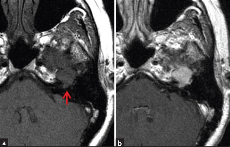 Contrast-enhanced brain magnetic resonance imaging. (a) Unenhanced T1-weighted sequence demonstrates T1 isointense mass along the course of the infratemporal portion of the left facial nerve (arrow). (b) Enhanced axial T1-weighted sequence demonstrates fairly homogeneous mass enhancement.