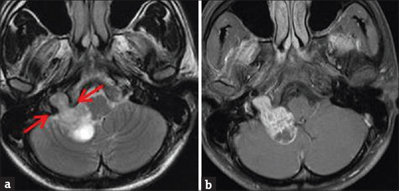 Contrast-enhanced brain magnetic resonance imaging. (a) Axial T2-weighted sequence demonstrates iso-to-hyperintense dumbbell-shaped mass extending across the right jugular foramen (arrows) into the posterior cranial fossa. (b) Enhanced T1-weighted sequence demonstrates heterogeneous enhancement.