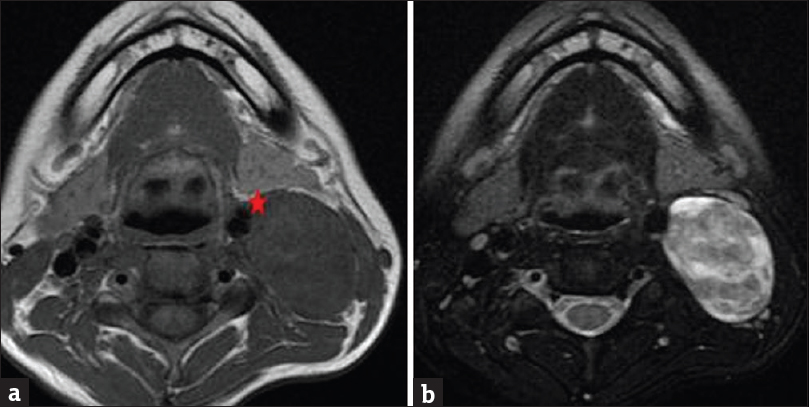 Magnetic resonance imaging of the neck without contrast. (a) Axial T1 sequence demonstrates large fusiform isointense mass within the left carotid sheath at level of the angle of the mandible. The mass displaces the carotid artery anteromedially (star). (b) Axial T2-weighted sequence demonstrates heterogeneous T2 signal, with areas of higher signal correlating with cystic degeneration.