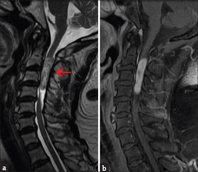 Contrast-enhanced cervical spine magnetic resonance imaging. (a) Sagittal T2-weighted sequence demonstrates heterogeneously T2 hyperintense intramedullary mass extending from C2-C4 spinal segments. (b) Enhanced T1-weighted sequence demonstrates nearly homogeneous mass enhancement. Pathology was consistent with schwannoma.