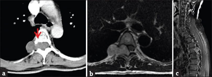 Contrast-enhanced CT and magnetic resonance imaging of the thoracic spine. (a) Axial contrast-enhanced CT image demonstrating a classic dumbbell-shaped mass with the waist located at the right T5/T6 neural foramen. Note the scalloping of the posterior aspect of the vertebral body (arrow).(b) Axial T2-weighted sequence demonstrates similar findings with isointense T2 mass signal. (c) Sagittal enhanced T1-weighted magnetic resonance imaging demonstrates heterogeneous mass enhancement.