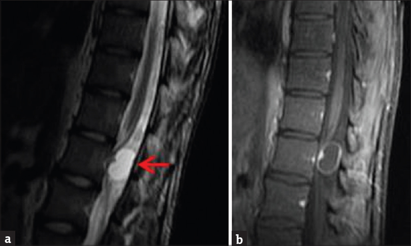 Contrast-enhanced magnetic resonance imaging of the lumbar spine. (a) Sagittal T2-weighted sequence demonstrates a small mass in the upper lumbar spine with primarily high T2 signal, consistent with cystic degeneration (arrow). (b) Enhanced T1-weighted sequence demonstrates mild enhancement of the noncystic portions of the mass.