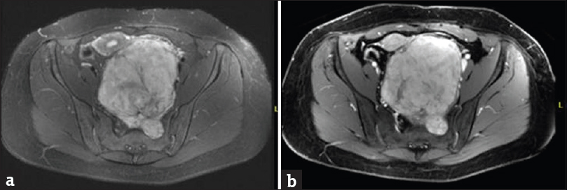 Contrast-enhanced magnetic resonance imaging of the pelvis. (a). Axial T2-weighted fat-saturated sequence demonstrates hyperintense presacral mass arising from a left sacral foramen and extending into the pelvis causing mass effect.(b) Enhanced spoiled gradient-recalled sequence demonstrates intense heterogeneous mass enhancement. Pathology was consistent with schwannoma.