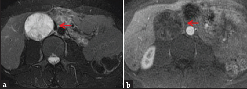 Contrast-enhanced magnetic resonance imaging of the abdomen. (a) Axial T2-weighted fat-saturated sequence demonstrates large, round primarily T2 hyperintense retroperitoneal mass (arrow). (b) Enhanced axial T1-weighted sequence demonstrates striations and peripheral rim-like enhancement (arrow). Lack of significant enhancement suggests cystic degeneration, which also correlates with the high T2 signal. Pathology consistent with schwannoma and also confirmed cystic degeneration.