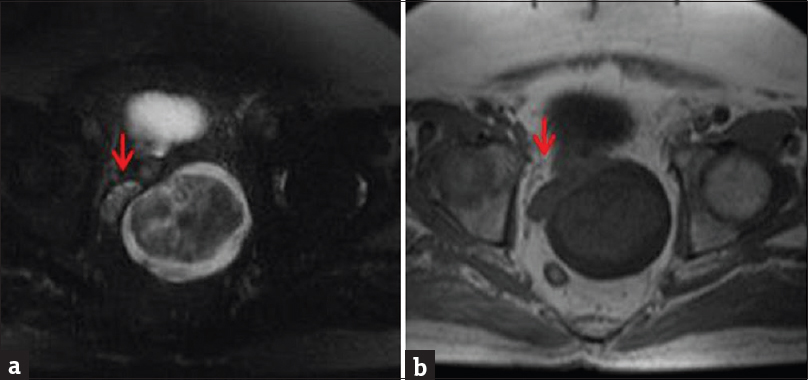 Magnetic resonance imaging of the pelvis without contrast. (a) Axial T2-weighted fat-saturated sequence demonstrates nonspecific enlargement of the left seminal vesicle by a mass with both cystic (high T2) and solid (isointense T2) components. The normal right seminal vesicle can be seen for comparison (arrow). (b) Axial T1-weighted sequence low T1 signal of the mass.