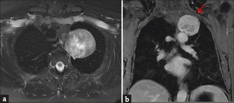 Contrast-enhanced magnetic resonance imaging of the chest. (a) Axial T2-weighted fat-saturated sequence demonstrates well-circumscribed, heterogeneously T2 hyperintense, extrapulmonary mass in the left lung apex. (b) Coronal enhanced T1-weighted sequence demonstrates heterogeneous enhancement, with smooth remodeling of the left 2nd rib (arrow). At surgery, this mass was closely associated with an intercostal nerve. Pathology was consistent with schwannoma.